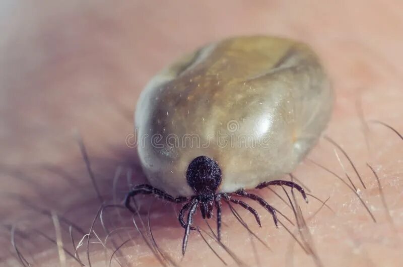 Клещ кровь фото Tick Filled with Blood Sitting on Human Skin Stock Photo - Image of ixodes, para