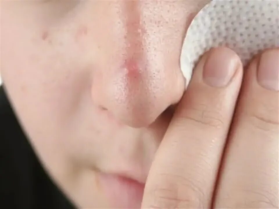 Клещ на носу фото How To Get Rid Of Blackheads.How To Get Rid Of Stretch Marks.How To Get Rid Of P