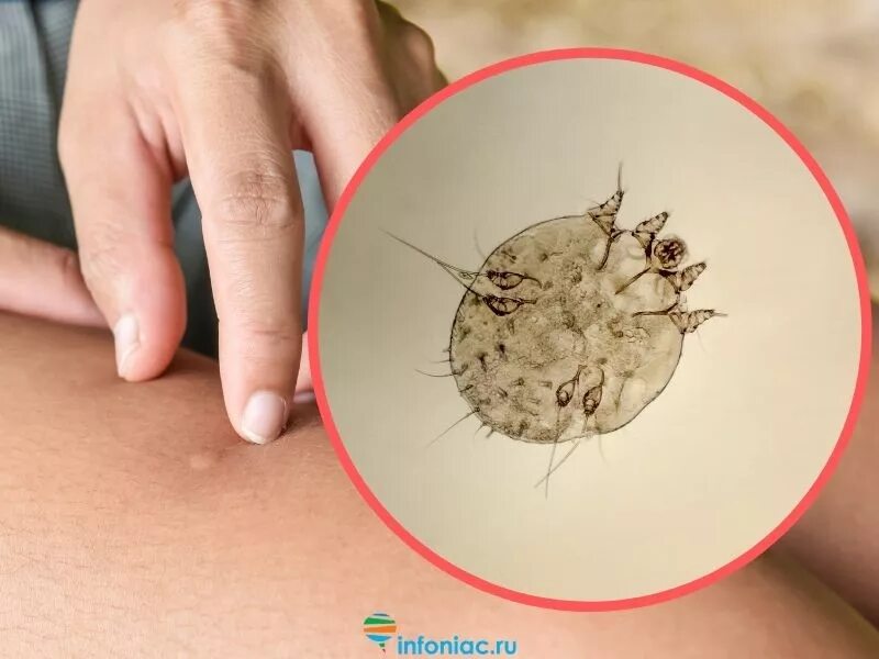 Клещ на спине фото Укусы насекомых - Учебный центр по первой помощи Местного отделения РКК МО Акаде