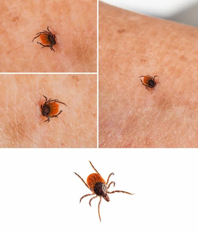 Клещ на теле фото и описание HOW TO SKIP THE PROBLEM OF BUGS UNDER THE SKIN Bug bite treatment, Insect bites 