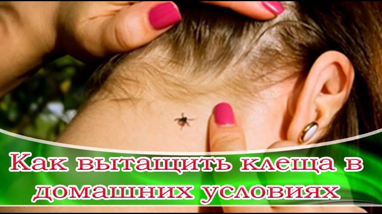 Клещ в ухе у человека фото ➤ Как вытащить клеща в домашних условиях. ➤ - YouTube