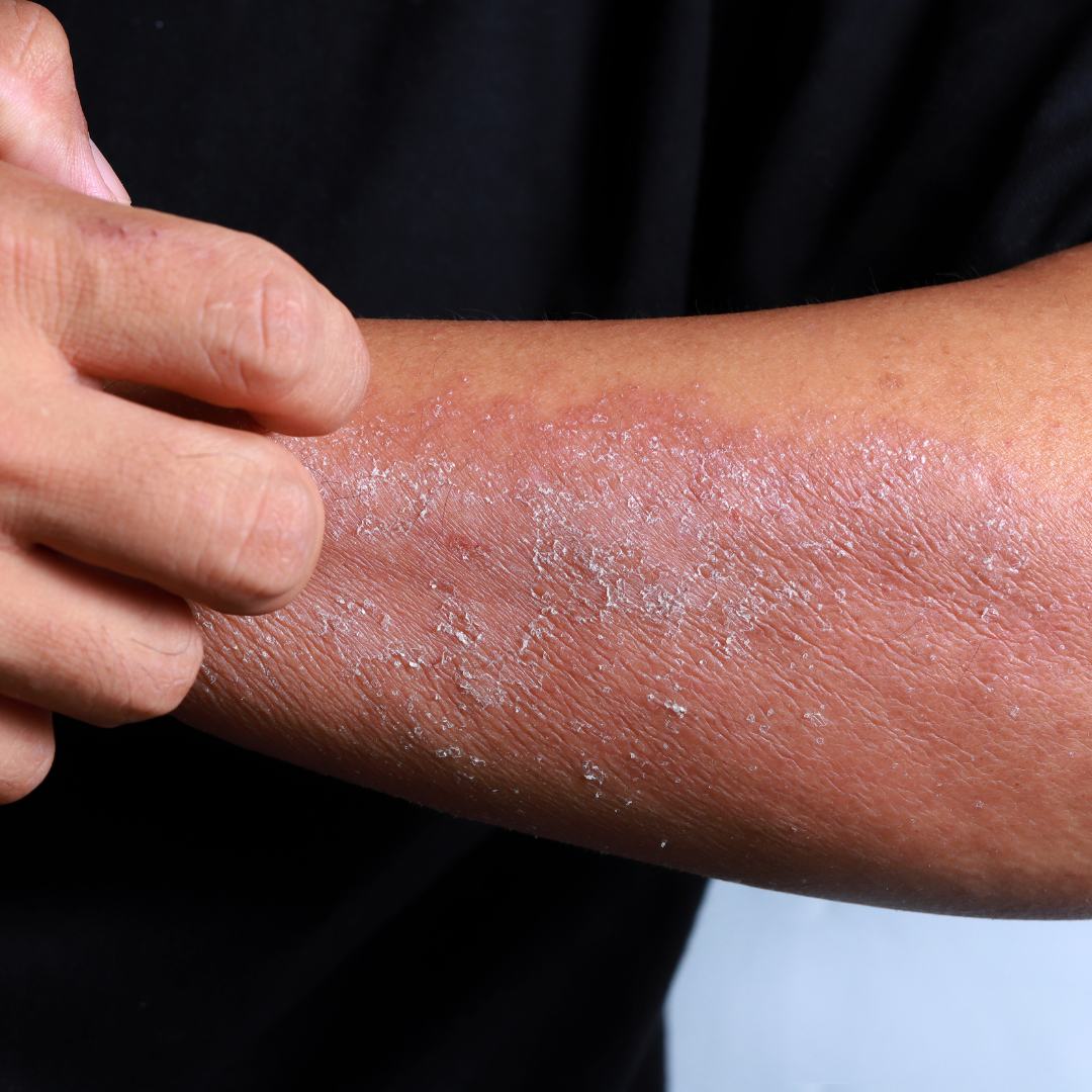 Клещевой дерматит фото Eczema: Who is Affected and What You Need to Know Sanova Dermatology