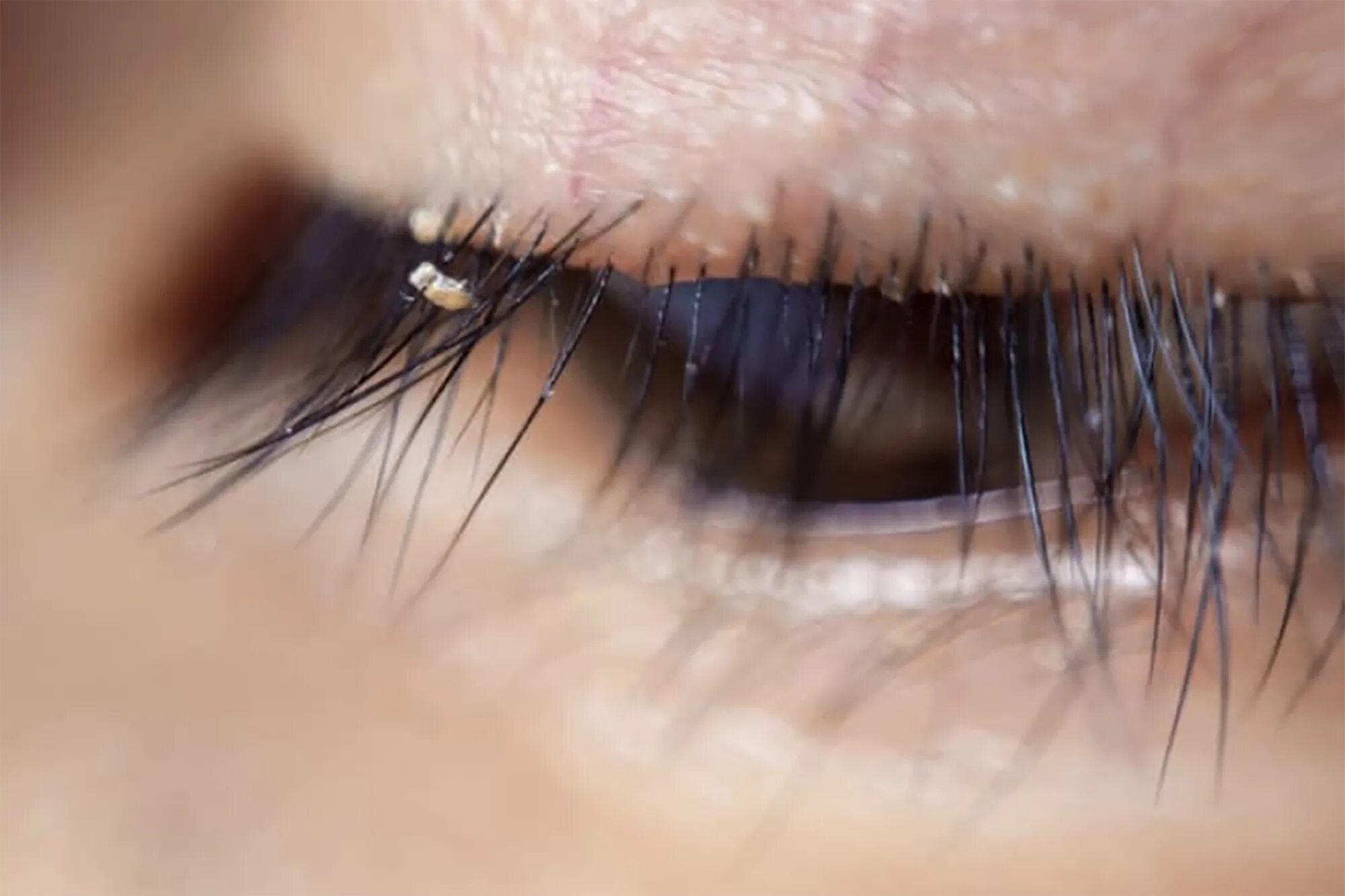 Клещи на ресницах человека фото Doctors warn about spread of eyelash lice due to extensions