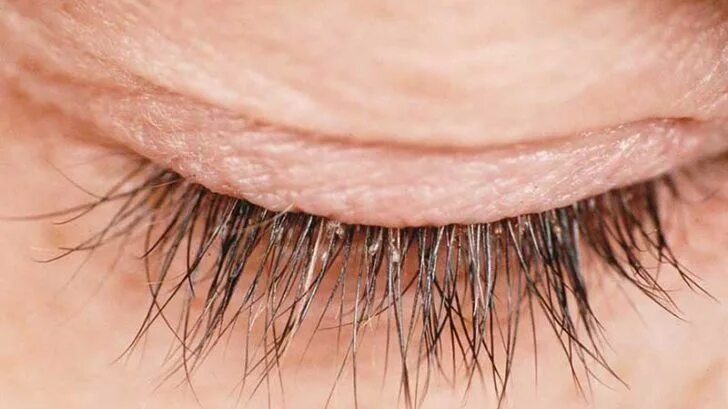 Клещи на ресницах человека фото Eliminer Naturellement les Taches Brunes sur le Visage en 2020 Cheveux secs et a