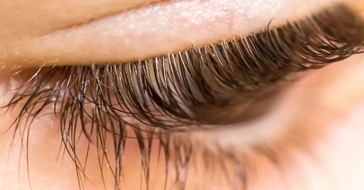 Клещи на ресницах человека фото Woman Discovers Over 100 Mites in Eyelashes Because of Unwashed Pillowcase Teen 
