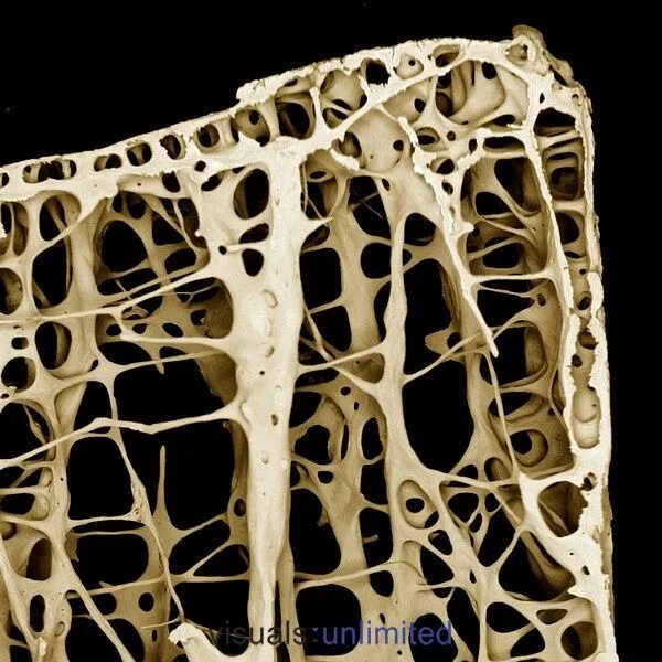 Клетки кости фото The bones of an 89 year old female with osteoporosis Βιολογία