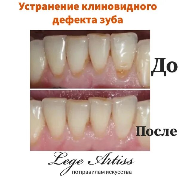 Клиновидный дефект зубов фото Клиновидный дефект стоматологическая карта лечение