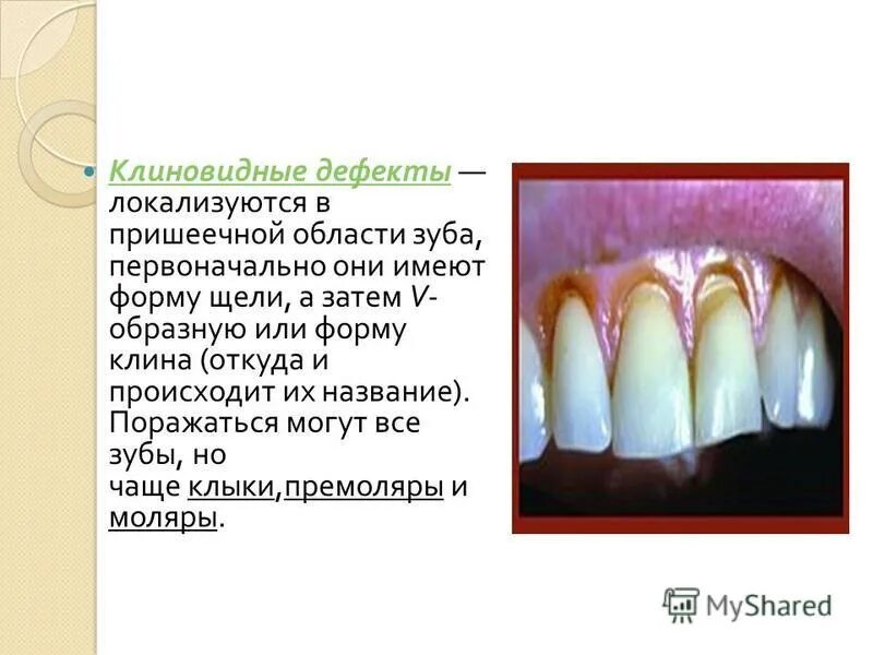 Клиновидный дефект зубов фото Клиновидный дефект стоматологическая карта лечение