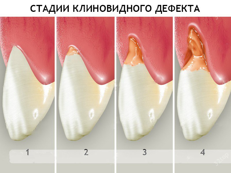 Клиновидный дефект зубов фото Лечение клиновидных дефектов зубов в клинике Dentserv: причины, методы, професси