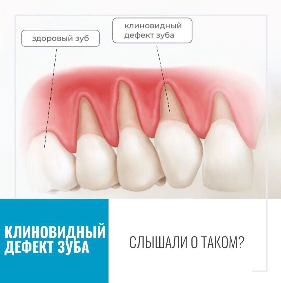 Клиновидный дефект зубов фото Новости медицины