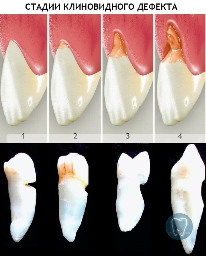 Клиновидный дефект зубов лечение фото Клиновидный дефект стоматологическая карта лечение