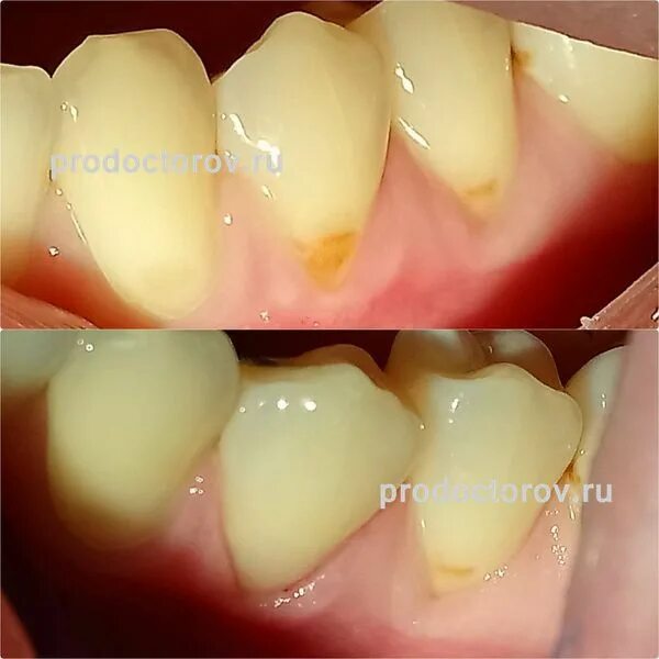 Клиновидный дефект зубов лечение фото Синицына Инна Сергеевна, стоматолог - 42 отзыва Нижний Новгород - ПроДокторов