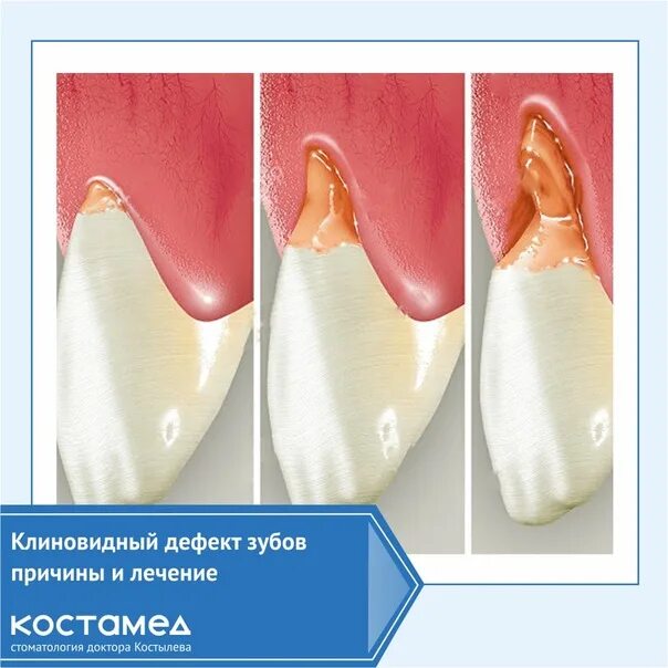 Клиновидный дефект зубов лечение фото Клиновидный дефект стоматологическая карта лечение
