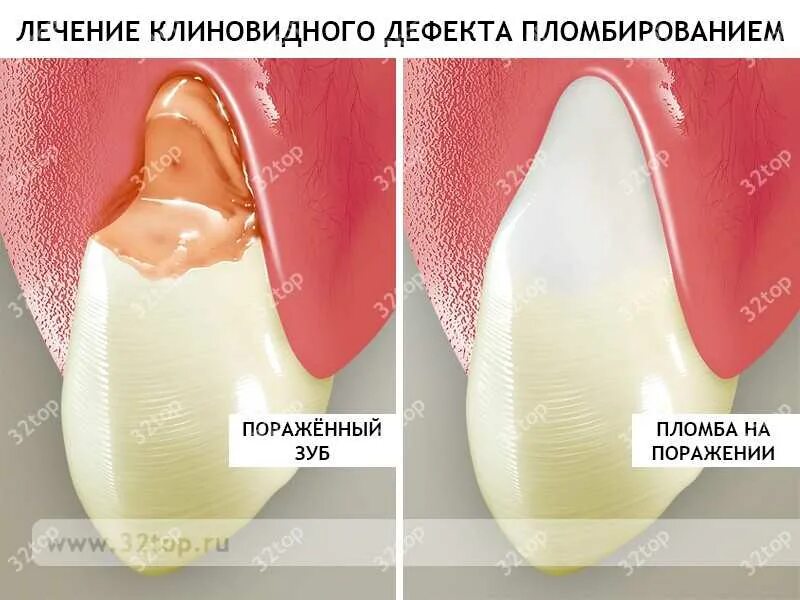 Клиновидный дефект зубов лечение фото Клиновидный дефект зубов: лечение, стадии и из симптомы