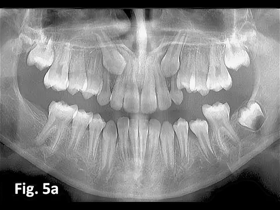 Клык зуб верхний фото HD Extraction of an Impacted Canine - YouTube - YouTube