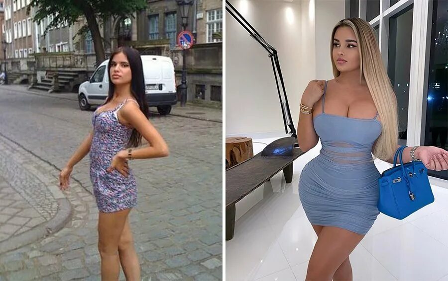 Квитко до и после пластики фото Без липосакции никак: 10 звезд, которым тела слепили хирурги КТО?ЧТО?ГДЕ? Пульс 