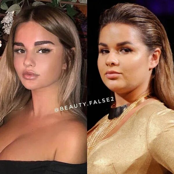 Квитко до и после пластики фото Анастасия Квитко в инстаграме/ в реальной жизни