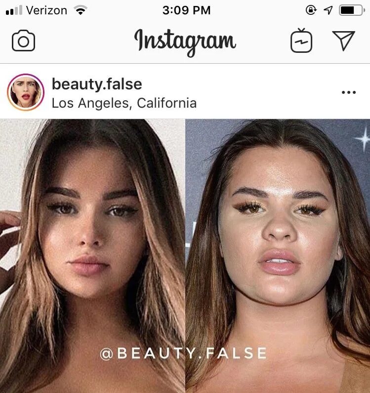 Квитко до и после пластики фото Квитко до и после пластики фото - PwCalc.ru