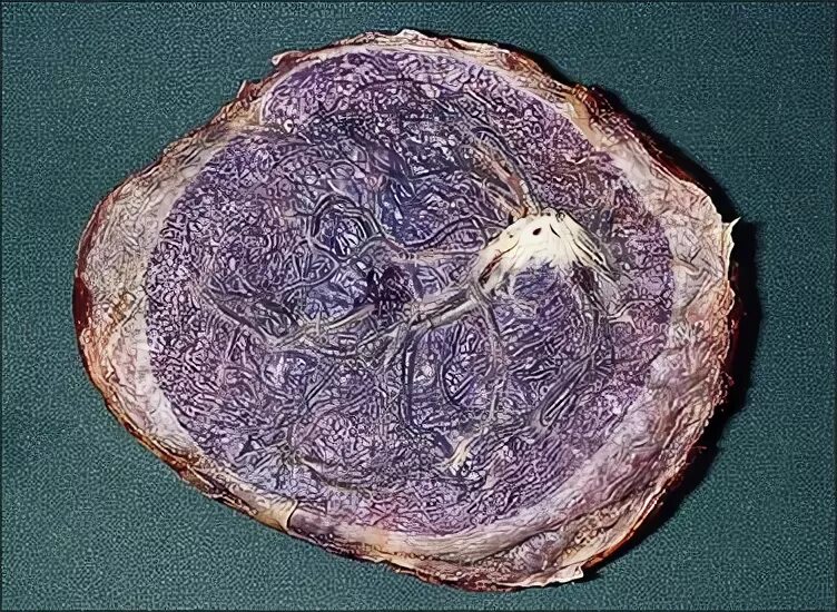 Плацента как выглядит после родов настоящая Implantation and Placenta Basicmedical Key