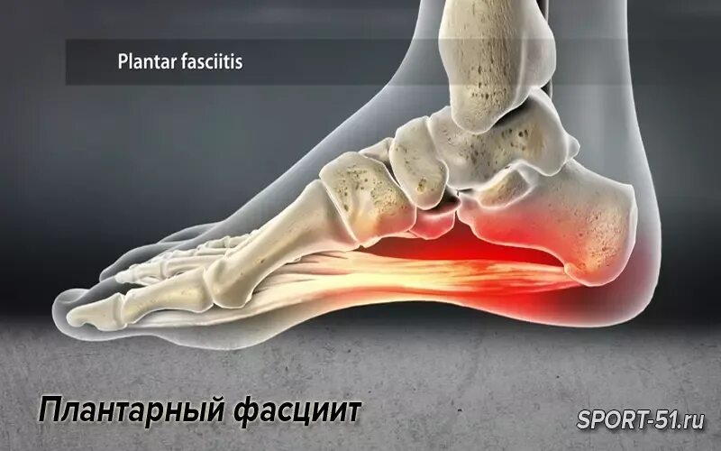 Плацентарный фасциит стопа симптомы и лечение фото Плантарный фасциит " Спортивный Мурманск