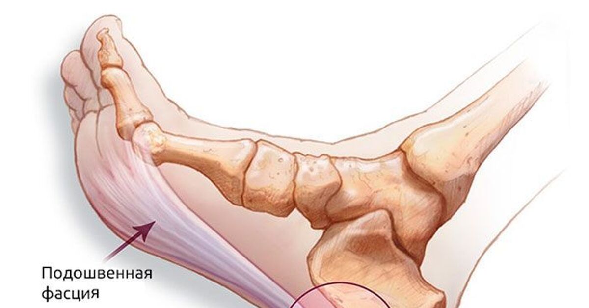 Плацентарный фасциит стопа симптомы и лечение фото Продолжение поста "Будни медицинского приема. Новый "метод" лечения пяточной шпо