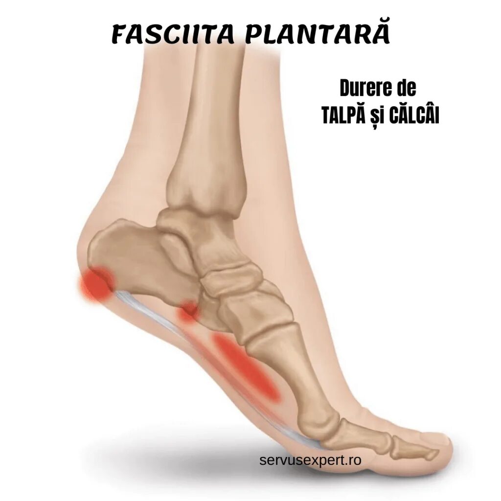 Плацентарный фасциит стопа симптомы и лечение фото Fasciita plantară: durere de talpă și călcâi