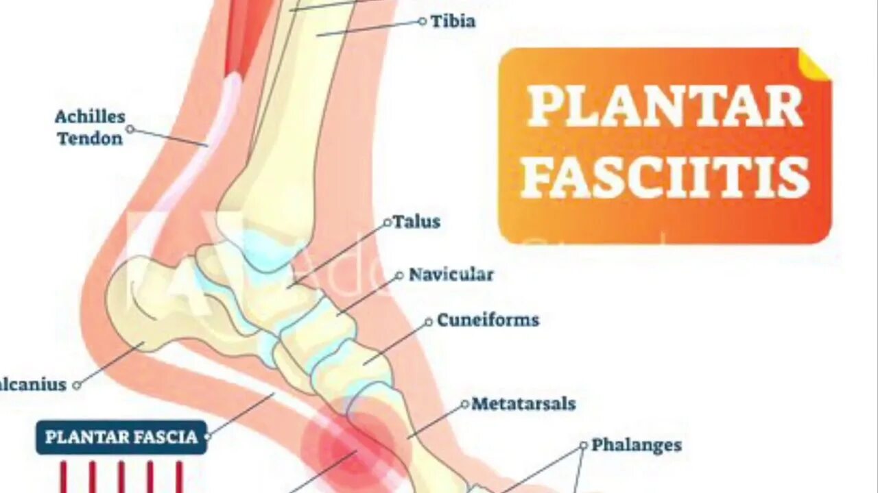 Плацентарный фасциит стопа симптомы и лечение фото Plantar Fasciitis - Physical Therapy Treatment - YouTube