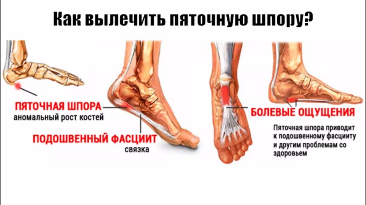 Плацентарный фасциит стопа симптомы и лечение фото Картинки ПРИЧИНА ФАСЦИИТА СТОПЫ