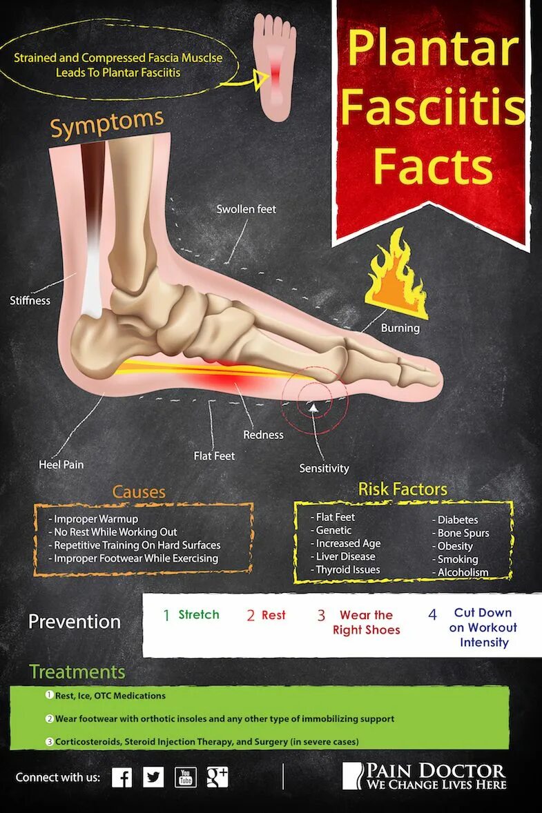Плацентарный фасциит стопа симптомы и лечение фото Pin on health