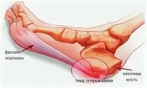 Плацентарный фасциит стопа симптомы и лечение фото Услуги - Частный кабинет подологии и ногтевого сервиса в Самаре
