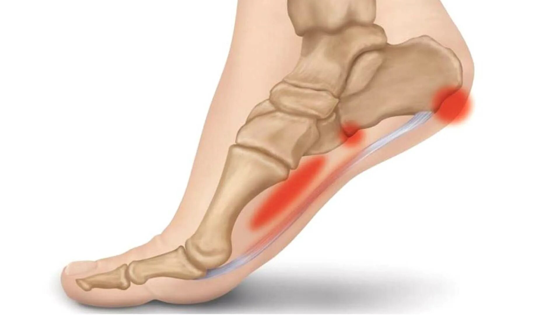 Плацентарный фасциит стопа симптомы и лечение фото Подошвенный фасциит мкб 10