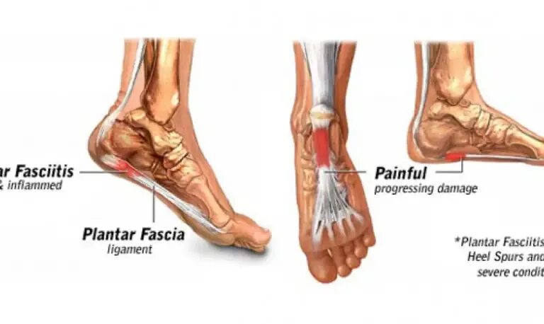 Плацентарный фасциит стопа симптомы и лечение фото Плацентарный фасциит стопа: найдено 86 изображений