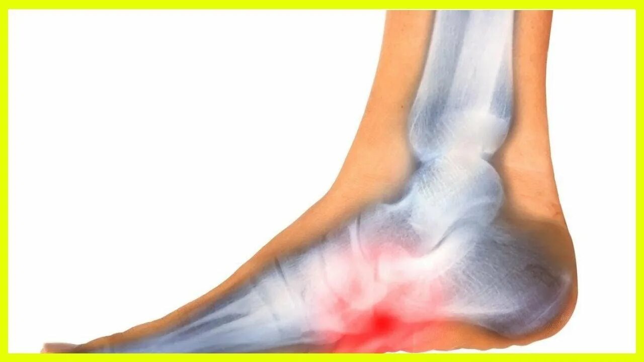 Плацентарный фасциит стопа симптомы и лечение фото Plantarfasziitis: Was ist das und was hilft dagegen? - YouTube