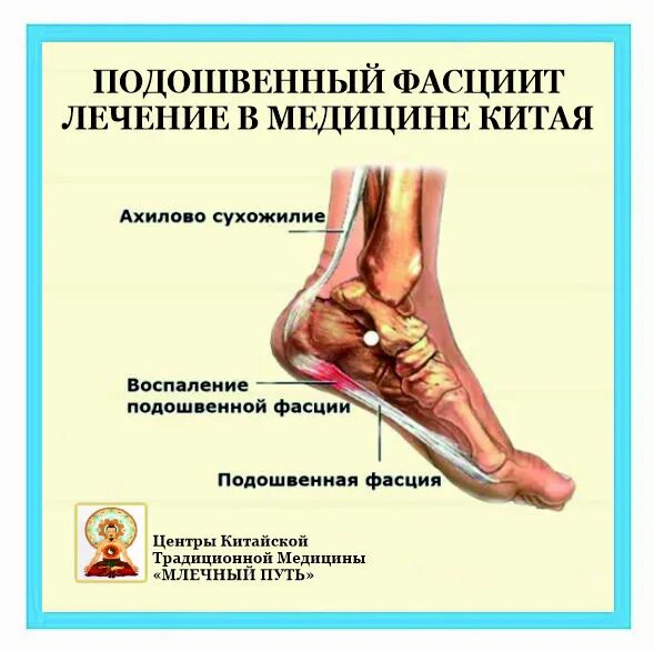 Плацентарный фасциит стопа симптомы и лечение фото МоёМесто.ru :: МедицинскийЦентр :: Фасциит