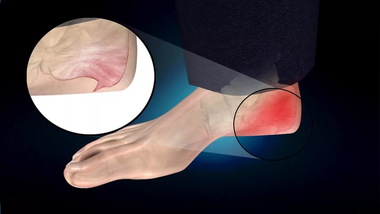 Плацентарный фасциит стопа симптомы и лечение фото Heel Spur or Calcaneal Spur: Treatment, Causes, Symptoms, Prevention - YouTube