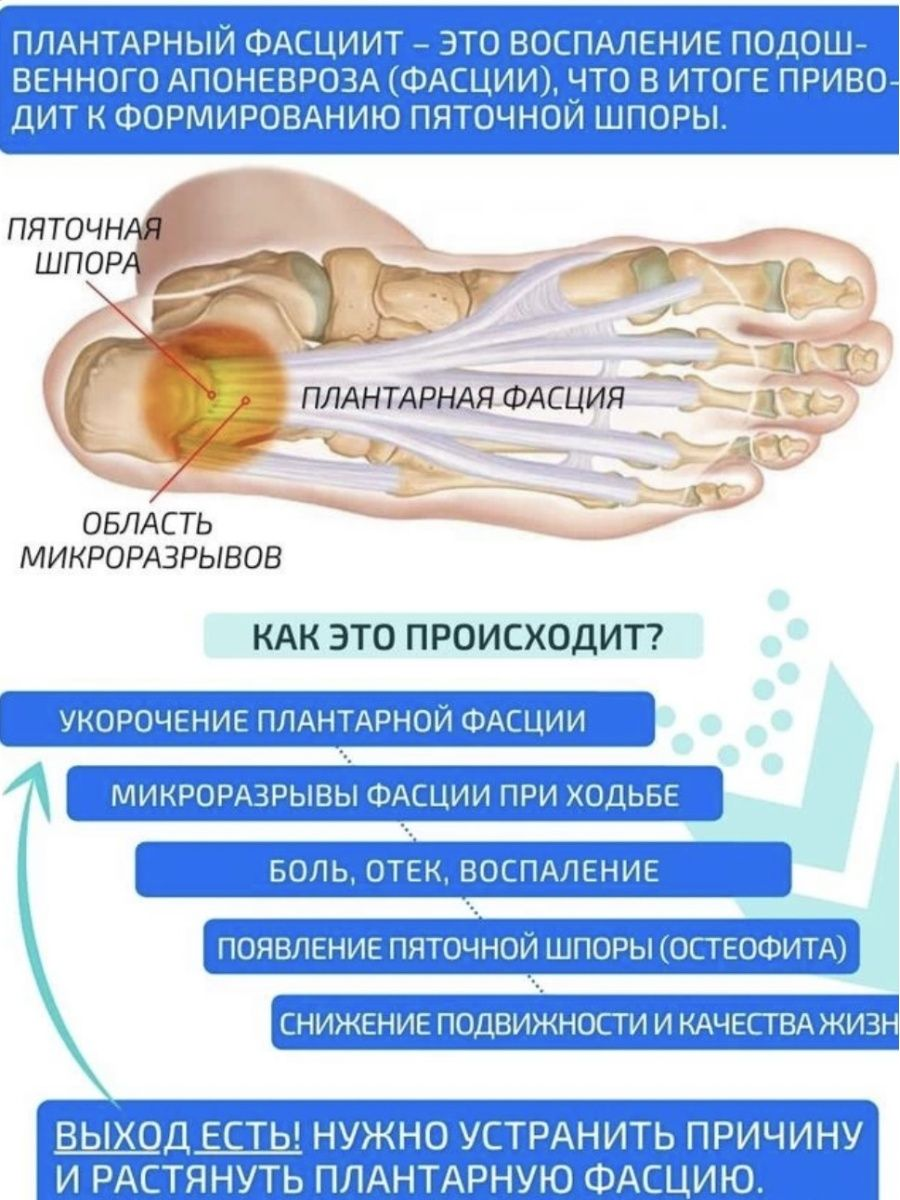 Плацентарный фасциит стопа симптомы и лечение фото Носок-ремень для растяжки голеностопного сустава синий - купить в интернет-магаз