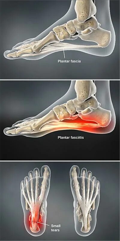 Плацентарный фасциит стопа симптомы и лечение фото Feiss Heel Injury Humerus Sale Online veter-komforta.ru