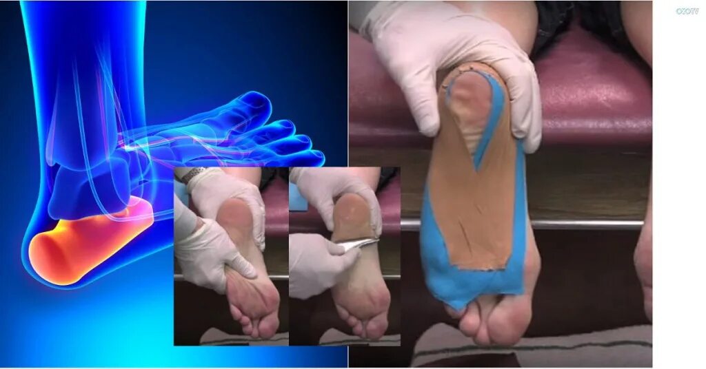 Плацентарный фасциит стопа симптомы и лечение фото Пяточная шпора. Как побороть?