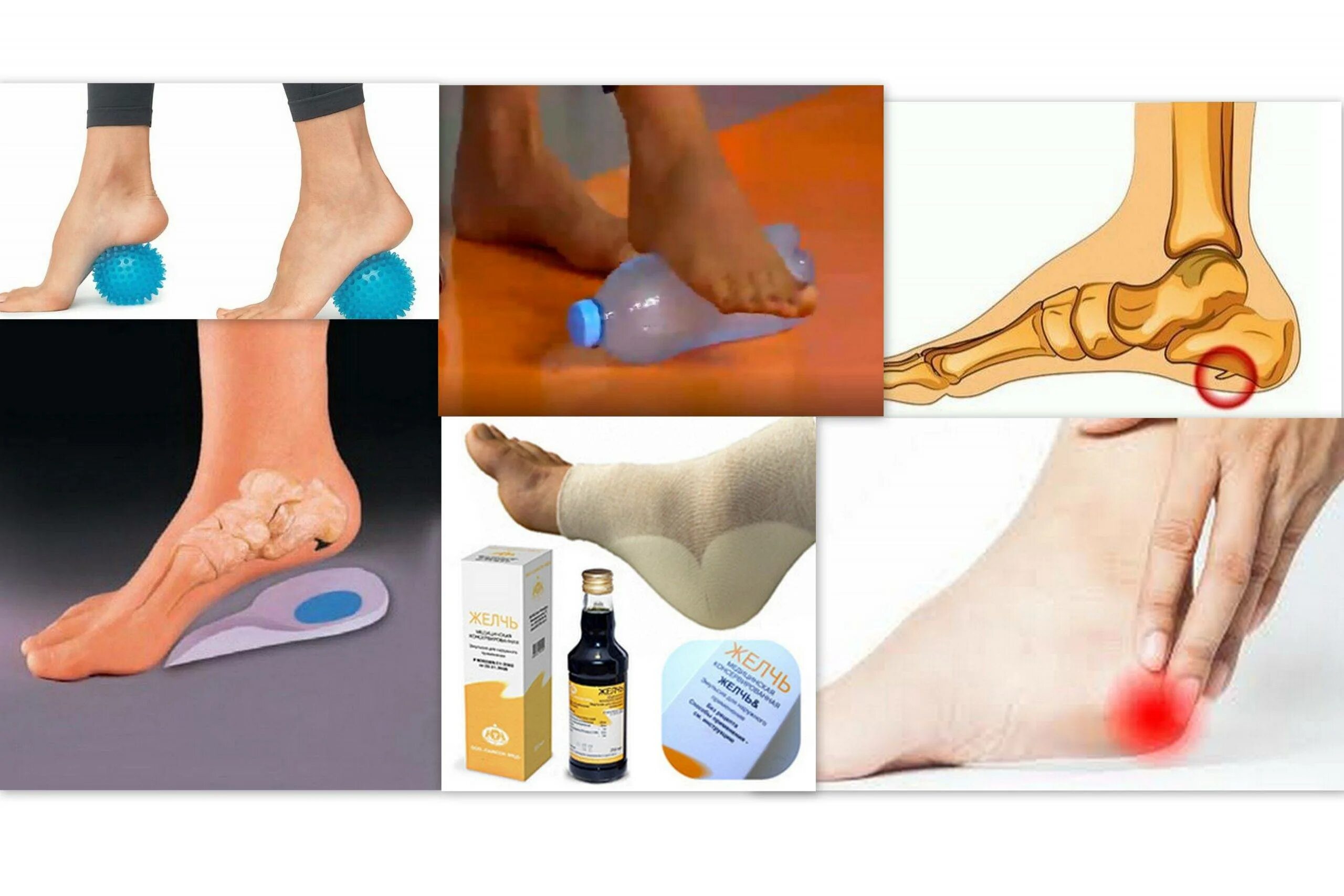 Плацентарный фасциит стопа симптомы и лечение фото Как лечить шпоры пяточной стопы: найдено 87 изображений