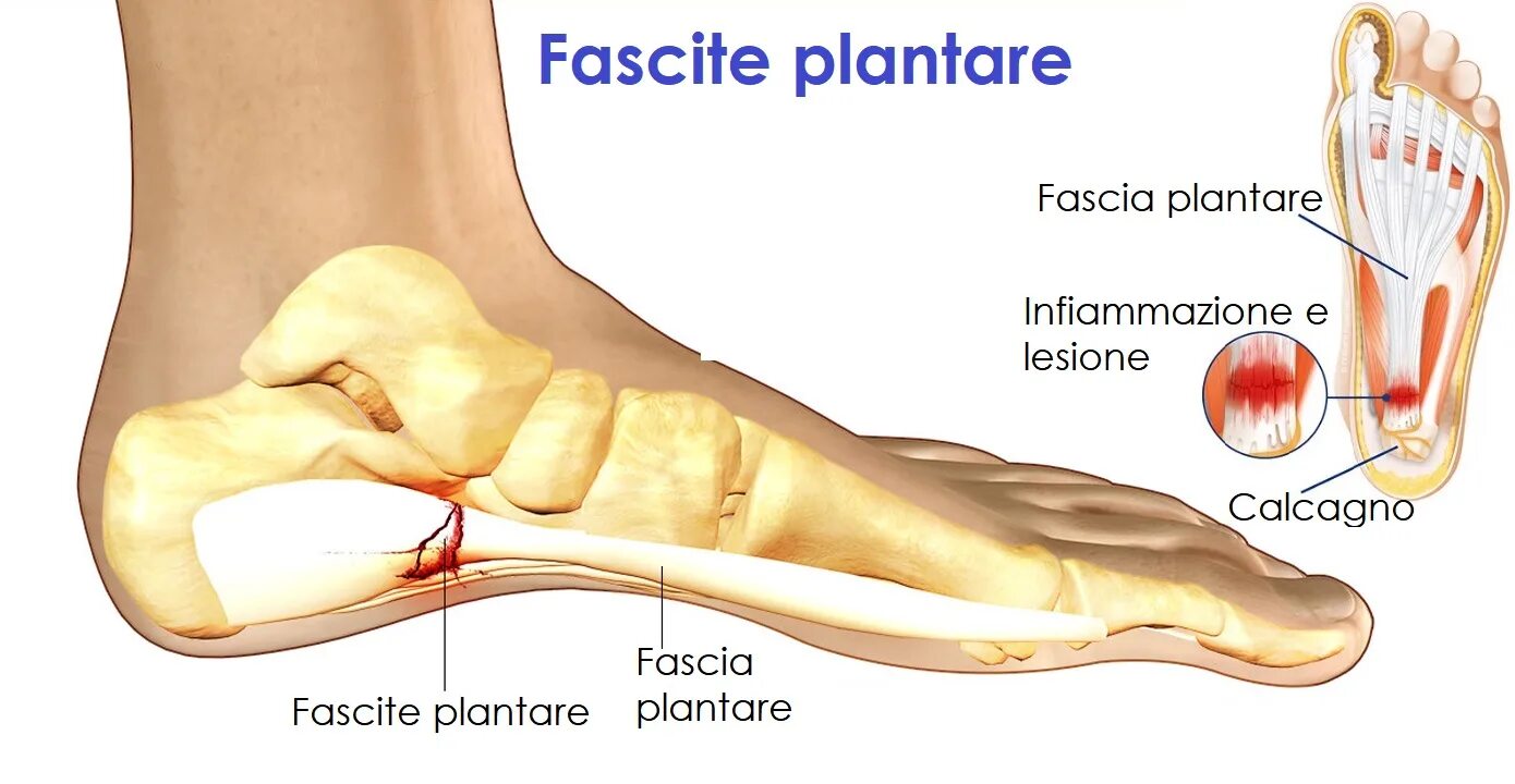 Плацентарный фасциит стопа симптомы и лечение фото subway General Classification dr martens dolore collo del piede pedestal Photoel