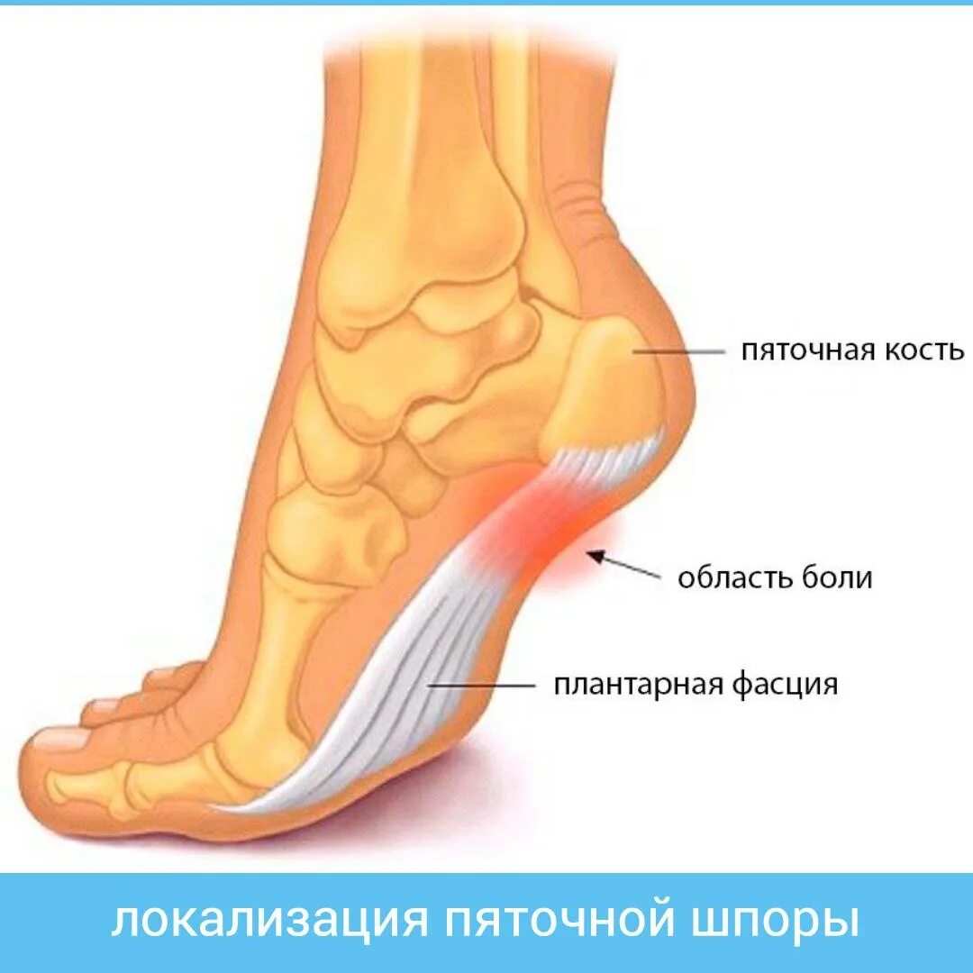 Плацентарный фасциит стопа симптомы и лечение фото Лечение пяточной шпоры