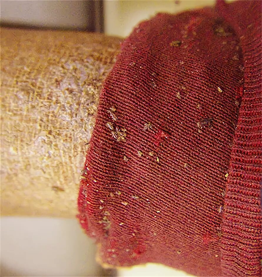 Платяная вошь фото как выглядит укусы Вши и симптомы их наличия