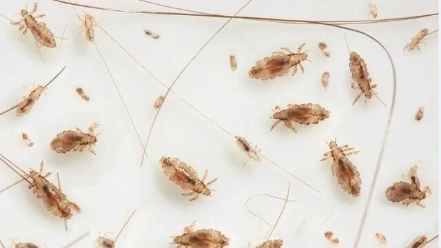 Платяная вошь как выглядят Head lice on the rise as summer heats up! #HeadLice Head Lice Lice remedies, Lic