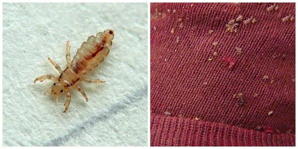 Платяная вша как выглядит Педикулез: что это, признаки и лечение; откуда берутся вши в статье аллерголога 