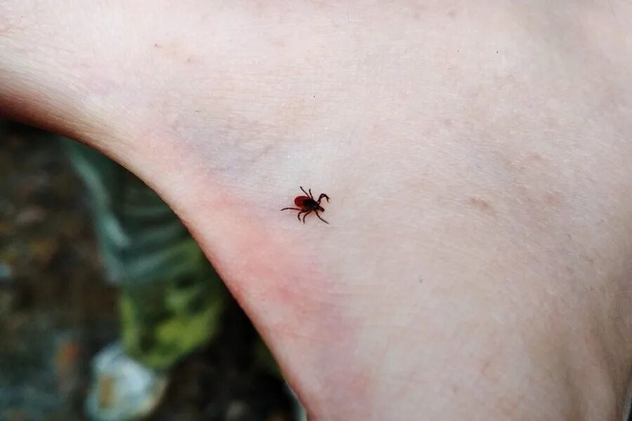 Платяной клещ укусы фото Больше 1,1 тысячи человек в Коми пострадали от укусов клещей - КомиОнлайн
