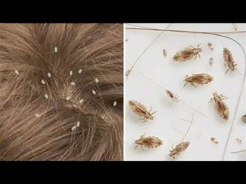 Платяные блохи укусы фото بماده طبيعيه هتقضي علي القمل وحشرات الشعر في١٢ ساعه - YouTube