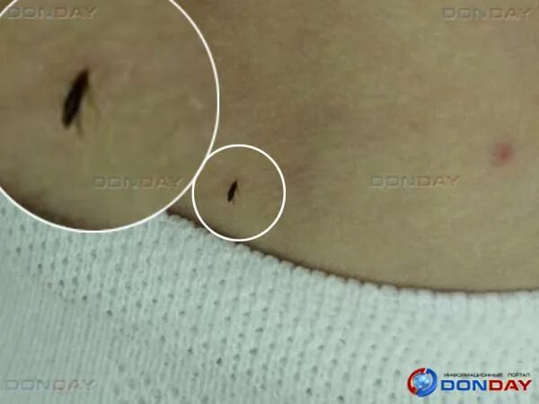 Платяные блохи укусы фото Donday.ru Версия для печати Блохи в детском саду Волгодонска: чем закончилась ск
