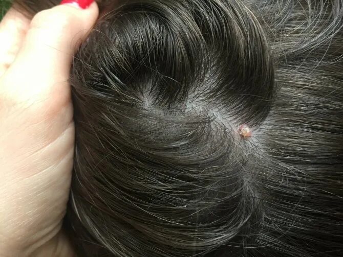 Платяные вши фото укусов Укусы вшей на теле и голове человека, фото