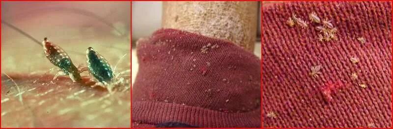 Платяные вши фото укусов Долго ли заживают укусы вшей. укусы вшей: как выглядят, особенности и способы ле