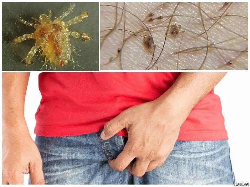 Платяные вши фото укусов на теле Про рудименты: теория, которая частично устарела, но которую